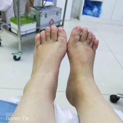 -派恩宜灰指甲鸡眼嵌甲手足癣