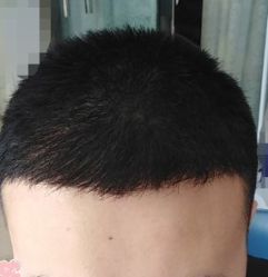 -大麦微针植发丨全国连锁