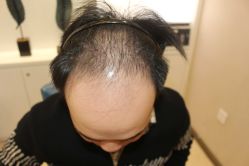 -大麦微针植发丨全国连锁
