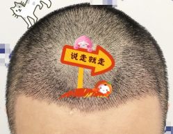 -大麦微针植发全国连锁