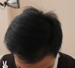 -大麦微针植发丨全国连锁