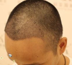 -大麦微针植发丨全国连锁