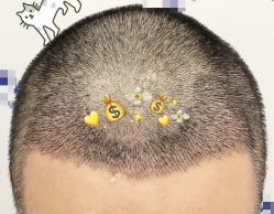 -大麦微针植发全国连锁