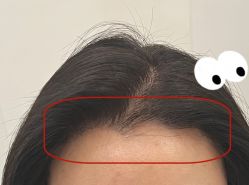 -大麦微针植发全国连锁