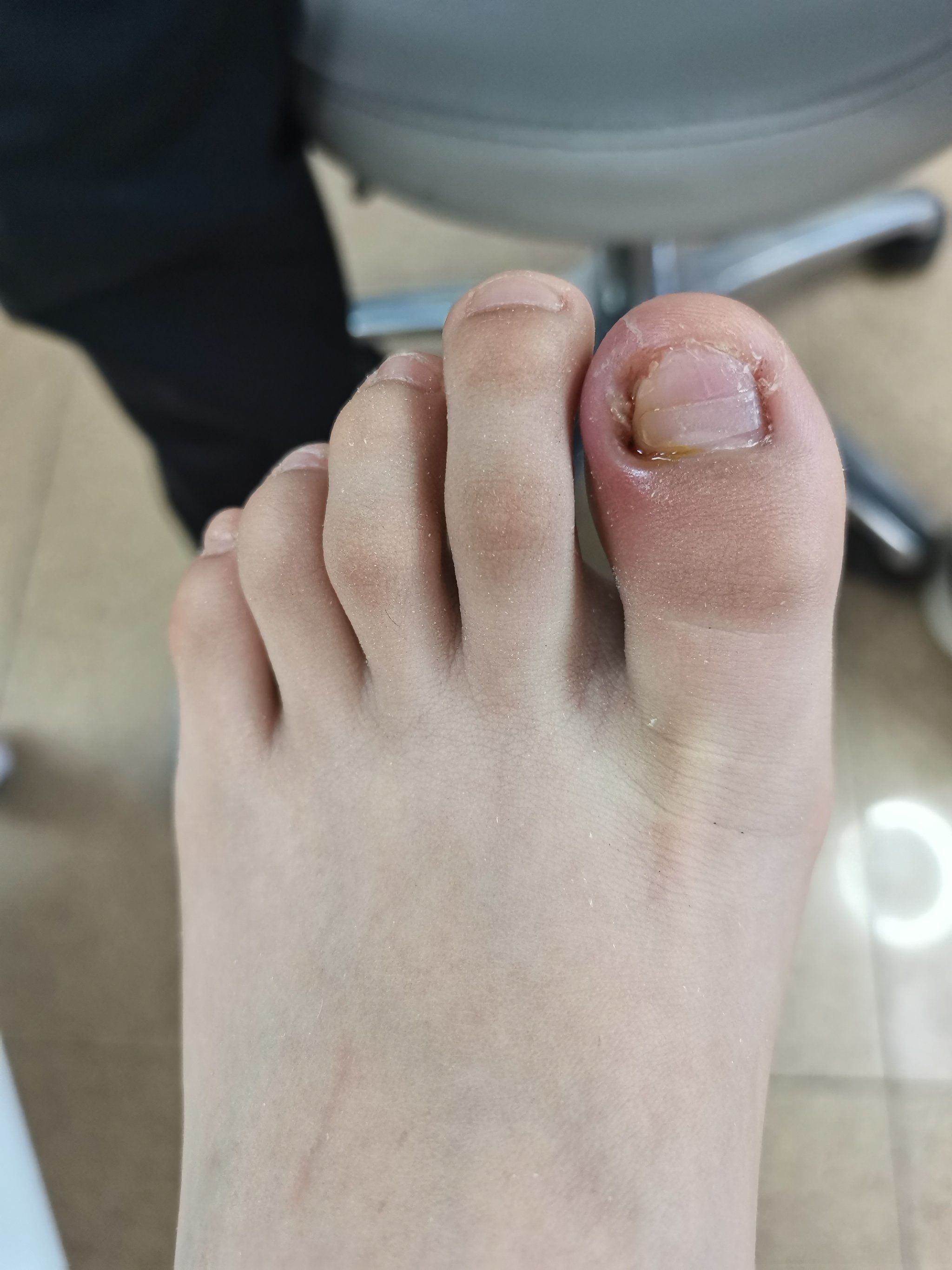 甲沟炎老是复发,唯有嵌甲矫正