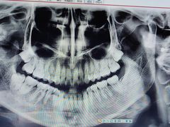 -赫尔森口腔·牙齿种植修复