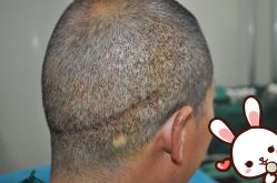 点击看大图 -大麦微针植发丨全国连锁