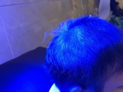 -碧莲盛·不剃发植发