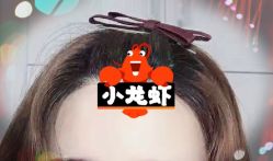 -大麦微针植发全国连锁