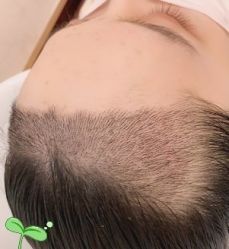 -大麦微针植发丨全国连锁