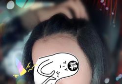 -大麦微针植发全国连锁