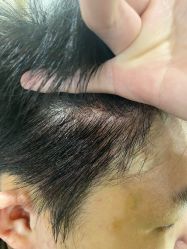 -碧莲盛·不剃发植发