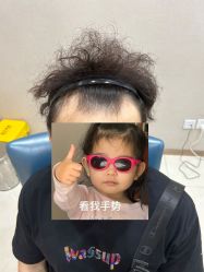 体验前-大麦微针植发丨全国连锁