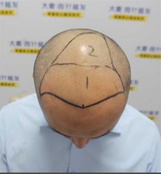 点击看大图 -大麦微针植发丨全国连锁