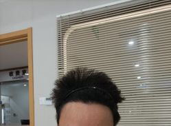 -大麦微针植发丨全国连锁