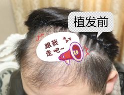 -大麦微针植发全国连锁