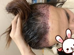 点击看大图 -大麦微针植发丨全国连锁