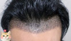 -大麦微针植发丨全国连锁