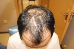 -大麦微针植发丨全国连锁