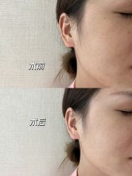 -广州健丽·去眼袋医疗美容机构