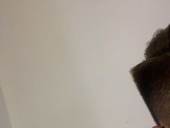 体验后-熙朵美学植发连锁