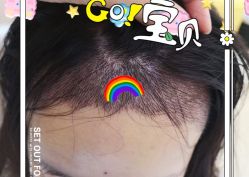 -大麦微针植发全国连锁