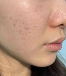 -痣斑堂·取大痣