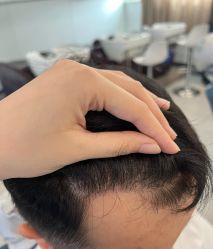 体验后-大麦微针植发全国连锁