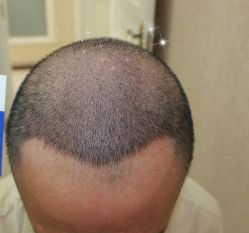 -大麦微针植发丨全国连锁