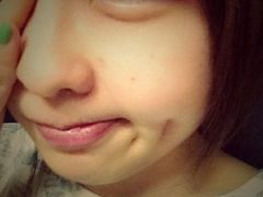 双眼皮第5天。。-上海华安整形外科门诊部