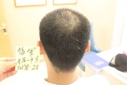 点击看大图 -大麦微针植发丨全国连锁