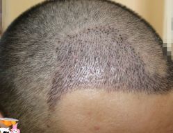 -大麦微针植发丨全国连锁