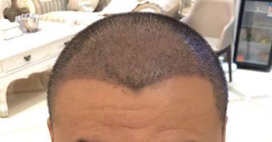 -大麦微针植发全国连锁