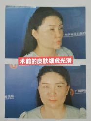体验前-伊丽莎白医疗美容