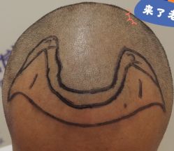 -大麦微针植发全国连锁