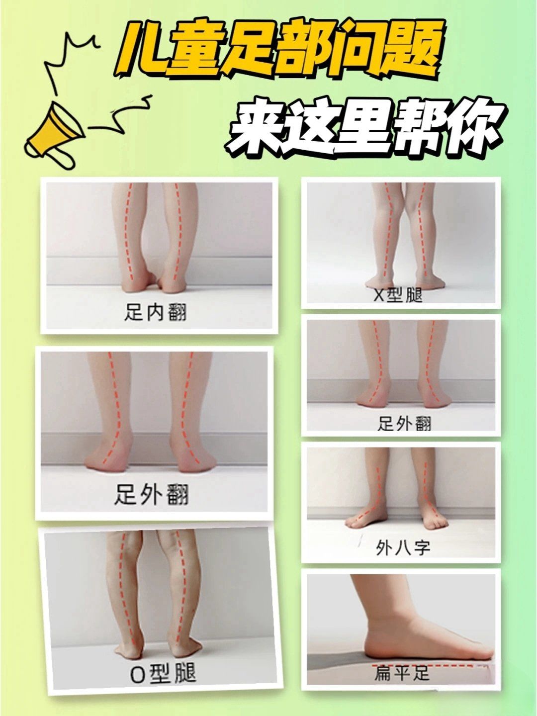 担心孩子足部与步态问题,多表现为扁平足,足外翻,足内翻,内八,外八,x