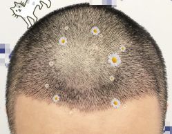 -大麦微针植发全国连锁