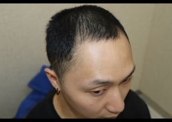 -大麦微针植发全国连锁