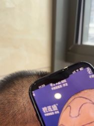 -碧莲盛·不剃发植发