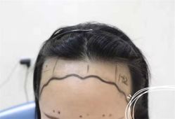 -大麦微针植发全国连锁