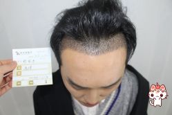 -大麦微针植发丨全国连锁