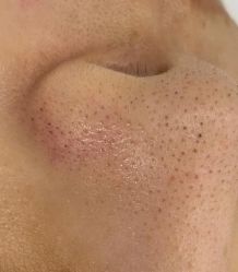 体验前-蕾特恩专业祛痘皮肤管理