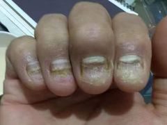-祖传修脚甲沟炎灰指甲鸡眼