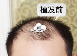 -大麦微针植发全国连锁