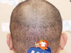 -大麦微针植发全国连锁