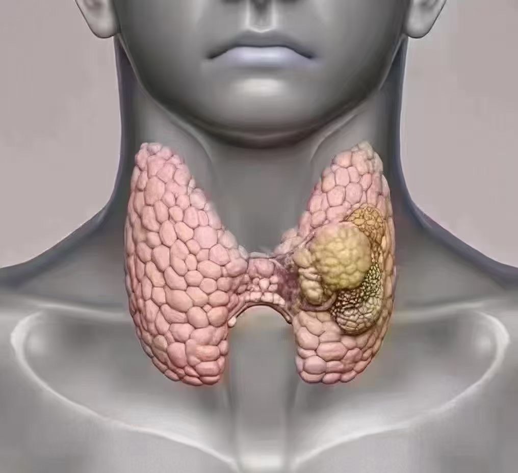 看甲状腺节结‬是如形何‬成的呢?