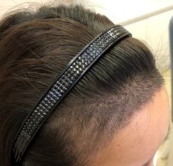 -大麦微针植发全国连锁