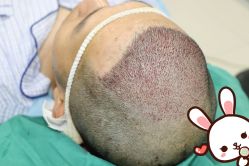 -大麦微针植发丨全国连锁