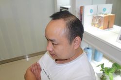 -大麦微针植发丨全国连锁