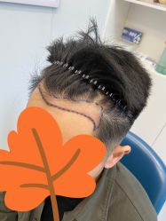 体验前-大麦微针植发全国连锁
